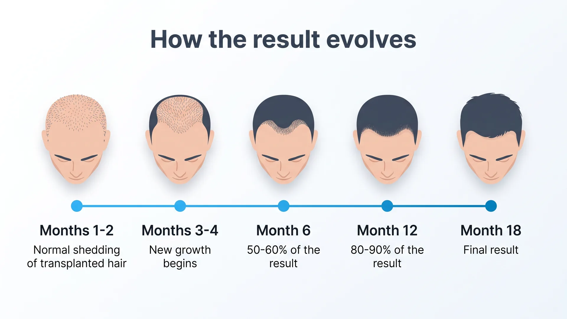 How the FUE result evolves: normal shedding in months 1 and 2, new growth in months 3 and 4, 50-60% of the result at month 6, 80-90% at month 12 and the final result at month 18